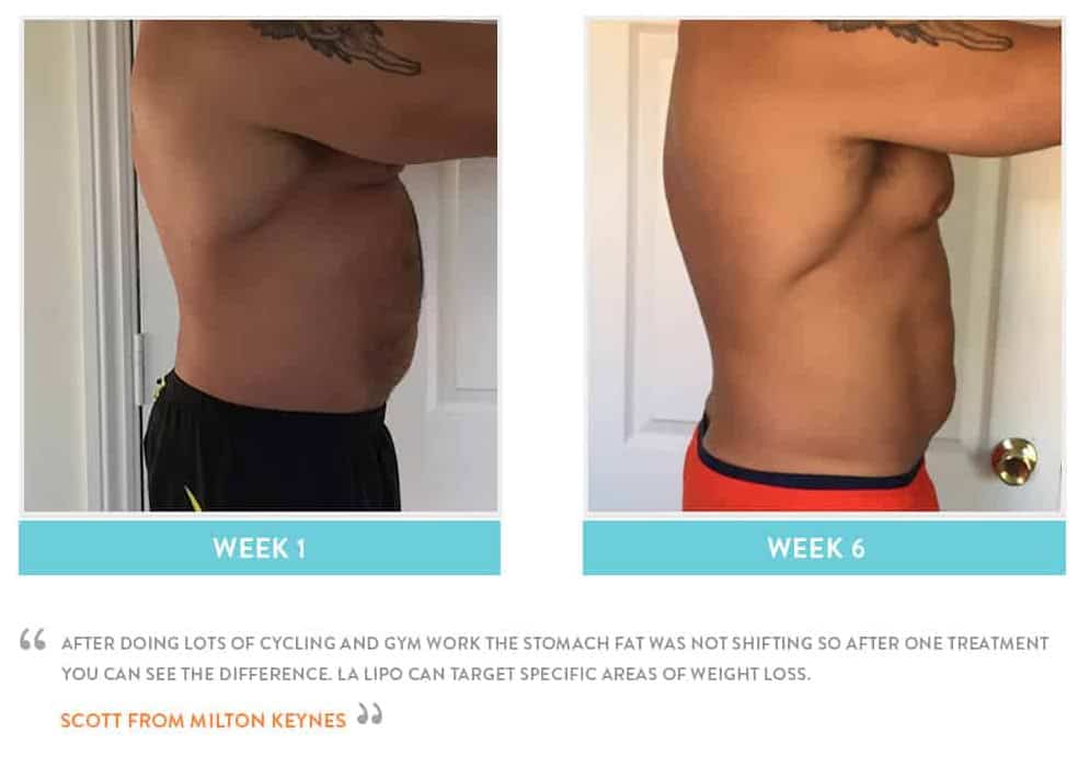 Before & After Stomach Fat High Wycombe