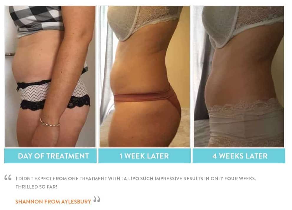 before, Cryolipolysis High Wycombe