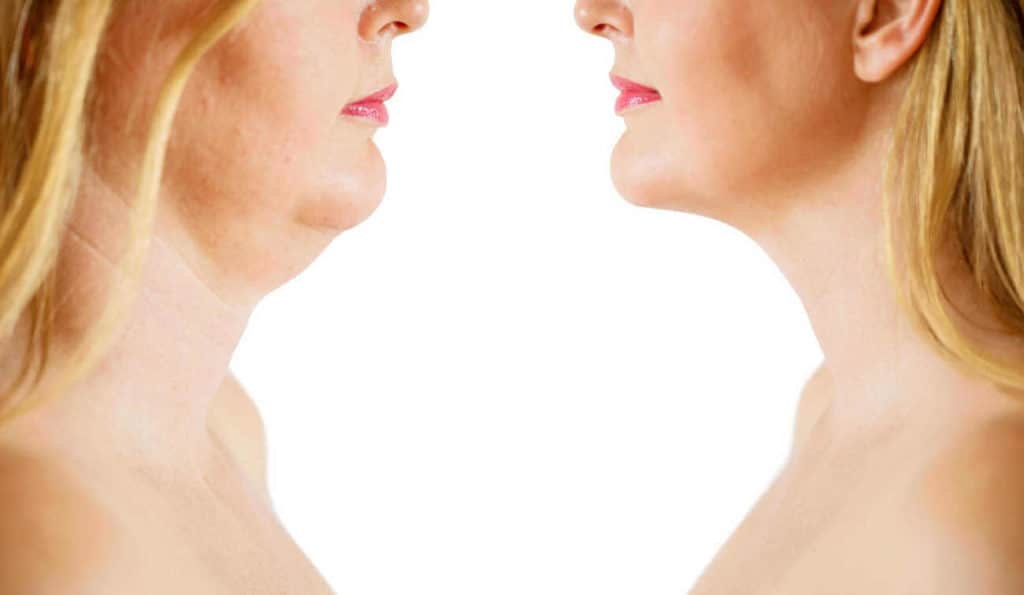 Double Chin treatment High Wycombe before and after results