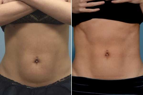 body sculpting FAQs High Wycombe