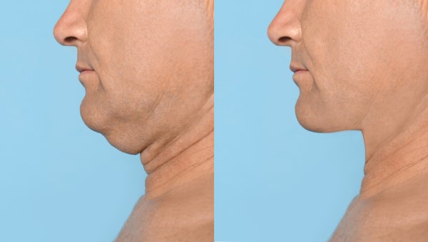 Which Non-Surgical Treatments Work Best for Jowls and Loose Skin High Wycombe?