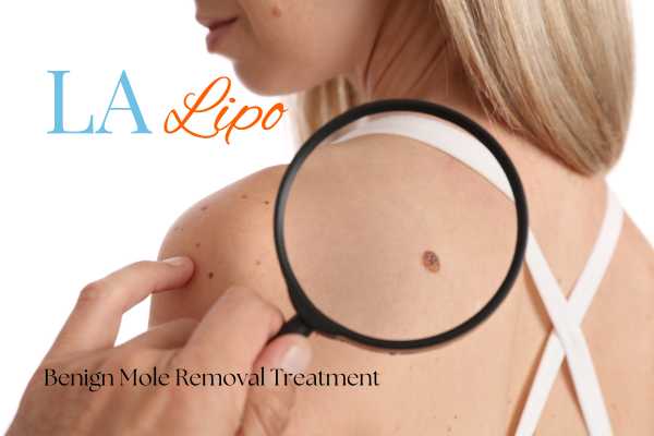 benign moles