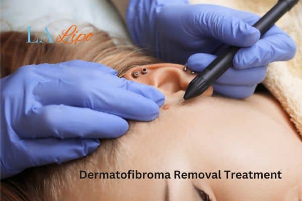 Dermatofibroma Removal Treatment High Wycombe
