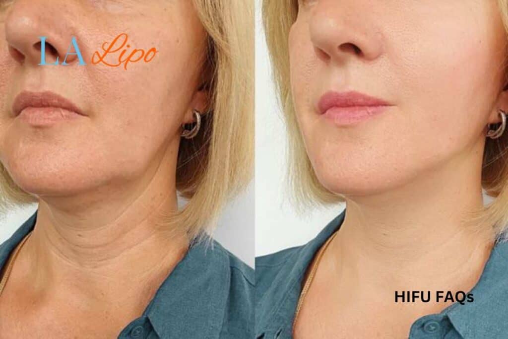 HIFU faq
