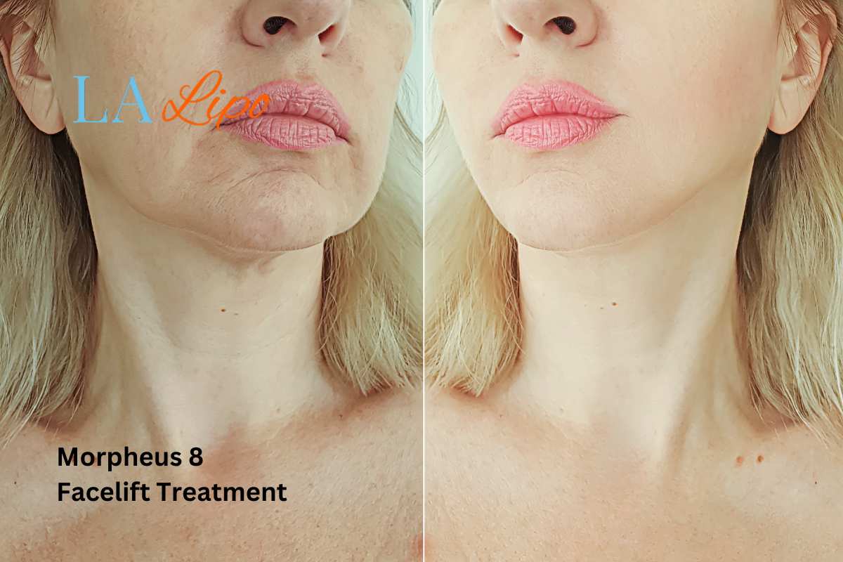 Turn back time with Morpheus8 Treatment High Wycombe