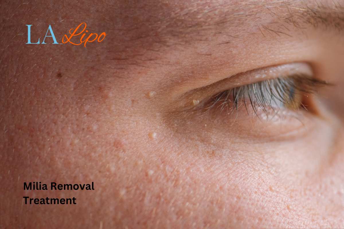Cryopen Milia Removal: Is It the Easiest and Safest Option High Wycombe?
