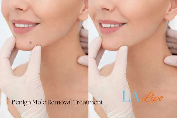 Woman's before and after results of being moles removal treatment High Wycombe