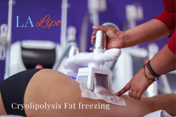 women getting fat freezing High Wycombe