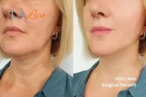 hi-fu for wrinkles High Wycombe before and after results