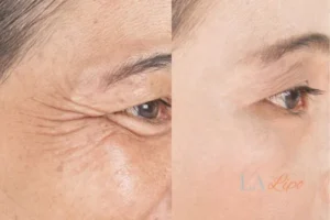 Before and after results of woman - HI-fu wrinkles reduction treatment High Wycombe
