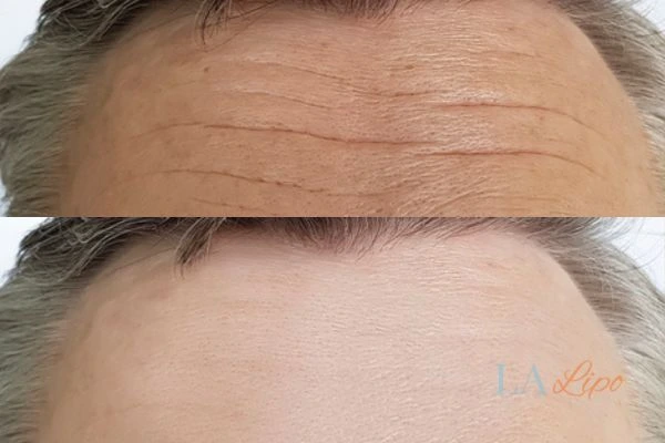 results of HIFU High Wycombe on mans forehead to help reduce lines and wrinkles