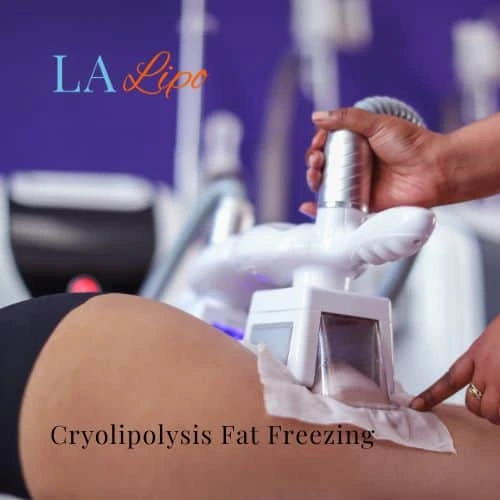 fat freezing - Cryolipolysis High Wycombe