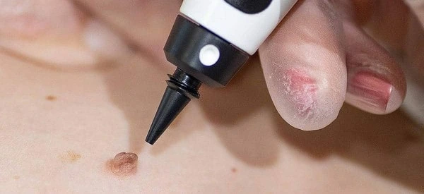skin tag removal using cryopen High Wycombe