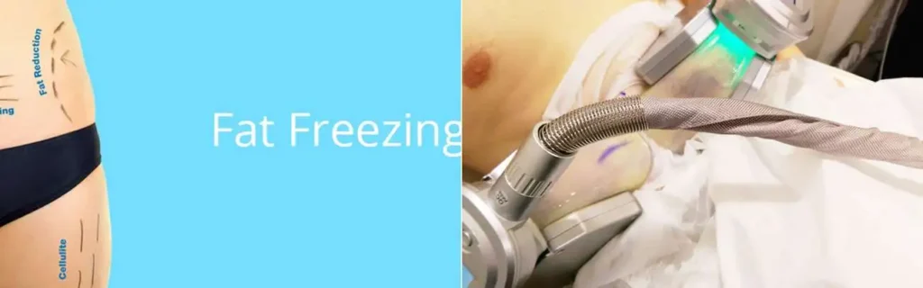 Fat freezing High Wycombe on multiple areas of the body
