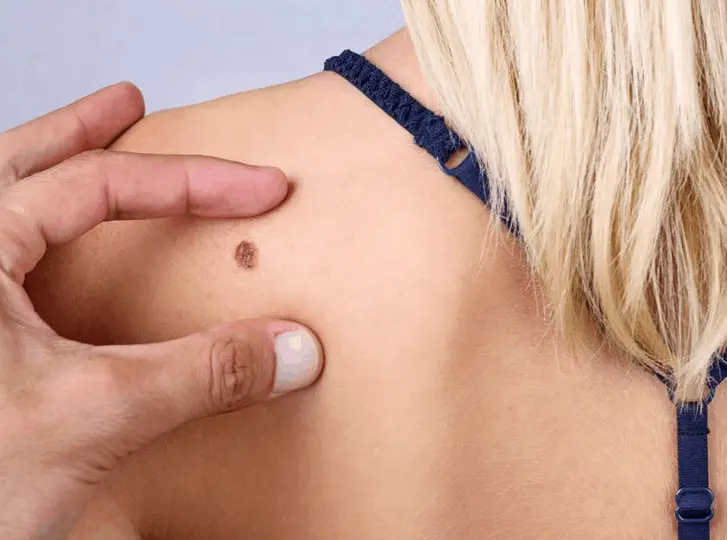 woman having mole removal High Wycombe consultation before treatment.