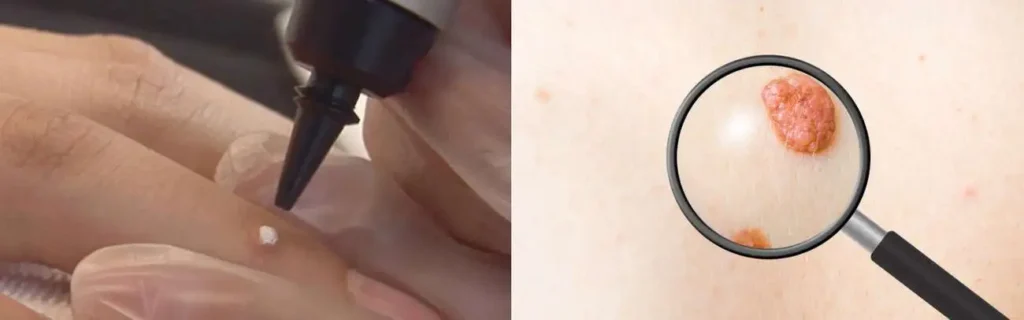 Cryopen for mole removal High Wycombe - speak to our team today!
