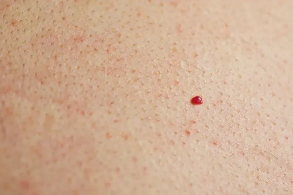 close up of a cherry angioma High Wycombe
