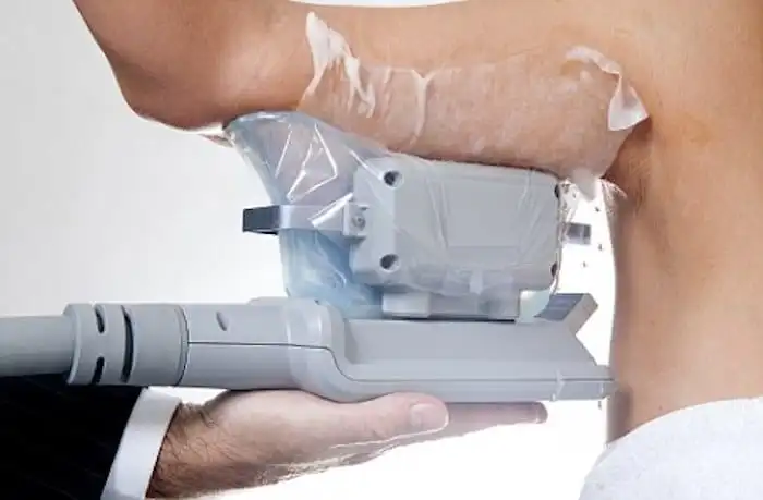 Picture of fat freezing High Wycombe on the upper arms.