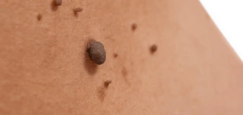 image of a skin tag High Wycombe