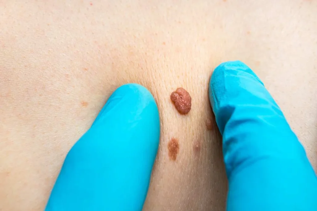 Consultant examining a skin tag High Wycombe