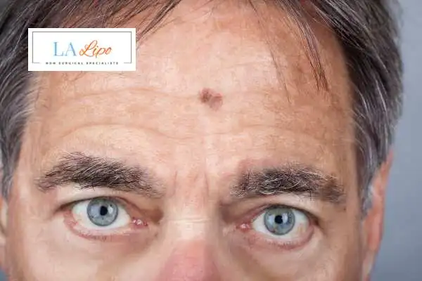 Solar Lentigo Removal High Wycombe image of man with mark on his forehead