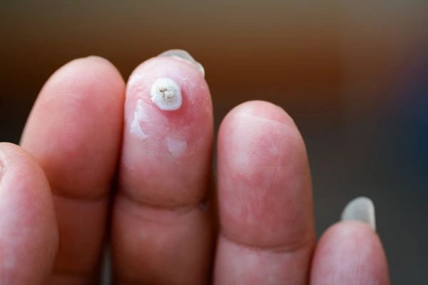 wart on person finger - cryotherapy to treat from LA LIPO High Wycombe