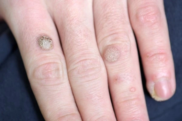 photo of warts on person hand - see wart removal High Wycombe from LA LIPO