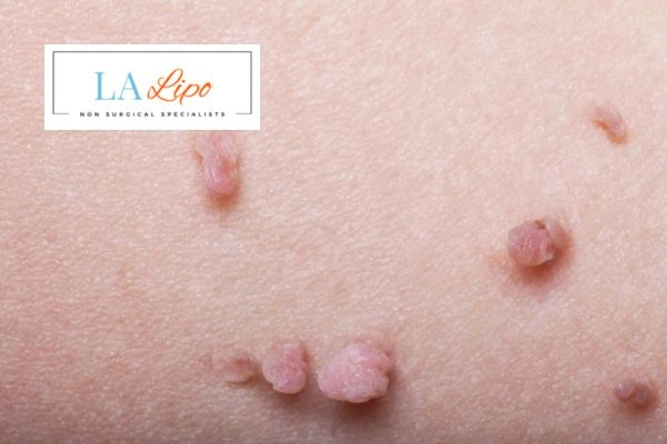Does cryopen skin tag removal High Wycombe hurt? Find out now call our team today!
