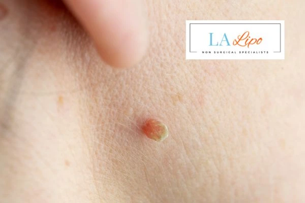 Book skin tag removal High Wycombe today speak to our team now!