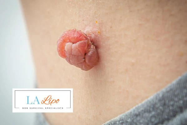 Interested in skin tag removal High Wycombe? Concerned about the pain? Find out more today!