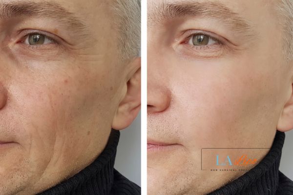 See the amazing results of Morpheus8 Treatment High Wycombe!