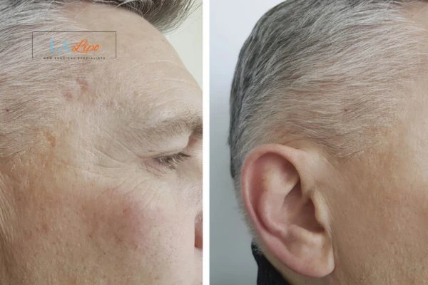 Mens Before & After Morpheus 8 Results High Wycombe