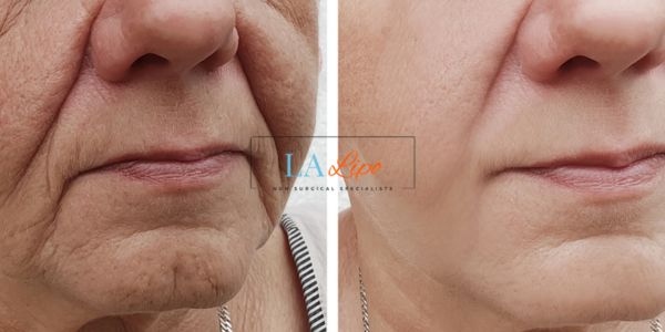 Older lady deeper wrinkle reduction - LA LIPO Morpheus 8 Results High Wycombe