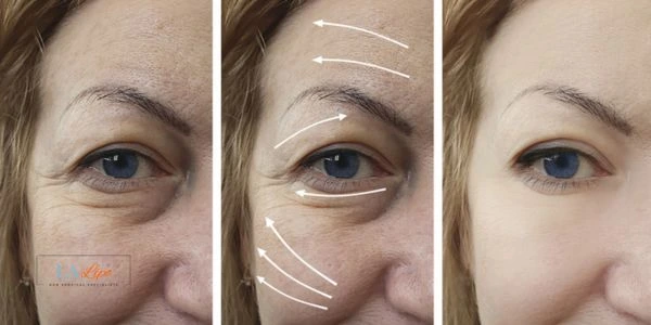 Amazing eye lift Morpheus 8 results High Wycombe