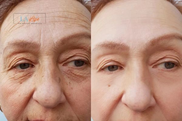The powerful benefits of Morpheus8 Treatment High Wycombe - Call Our team today!