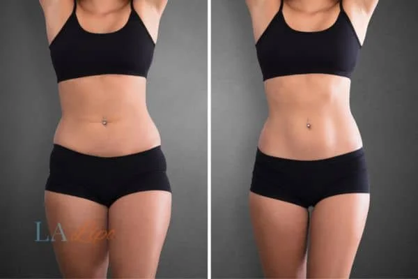 before and after results of non-surgical treatment to help a woman's body image and mental health High Wycombe