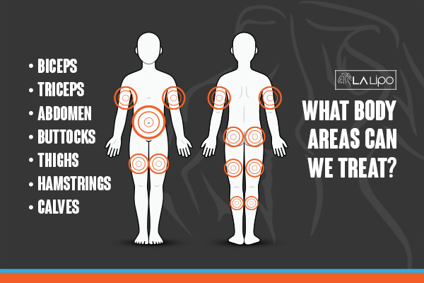 Diagram to show areas you can have LA-EMS Body Sculpting Treatment High Wycombe