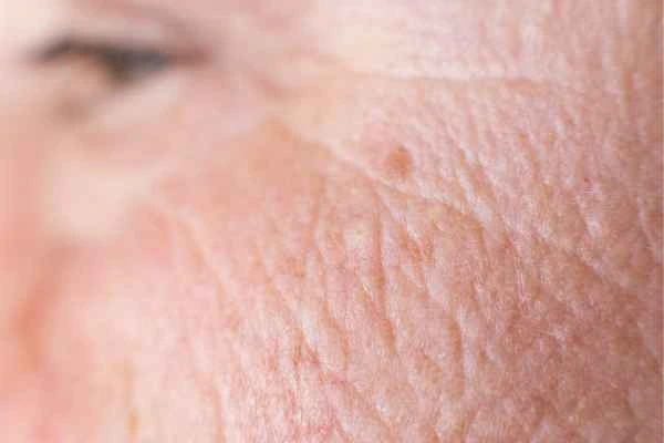 close up picture of a woman's face showing an age spot High Wycombe