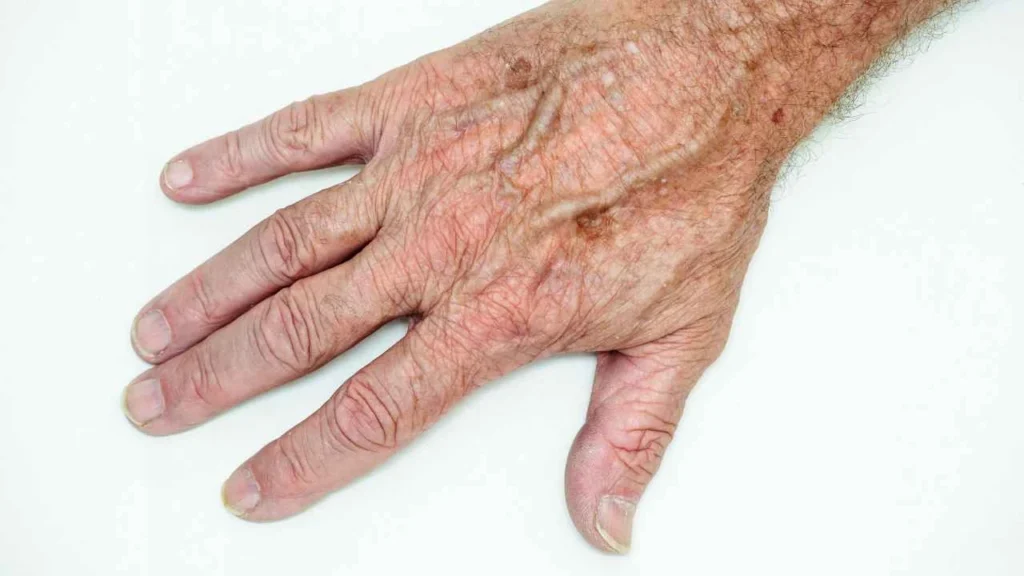 Male hand showing age spot High Wycombe