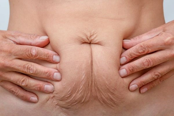 Image of a woman's stomach with loose skin - example of skin tightening High Wycombe options