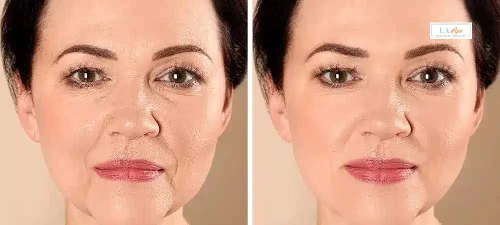 How Long Does It Take to See Results and How Long Do They Last High Wycombe?