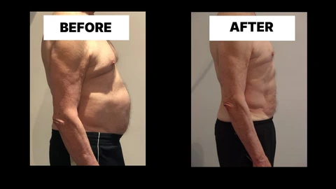 What Symptoms Can Diastasis Recti Cause in Men? Weak Core, Back Pain and Poor Posture High Wycombe